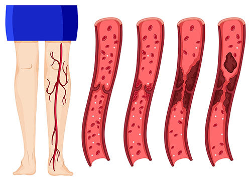 leg blood clot stages