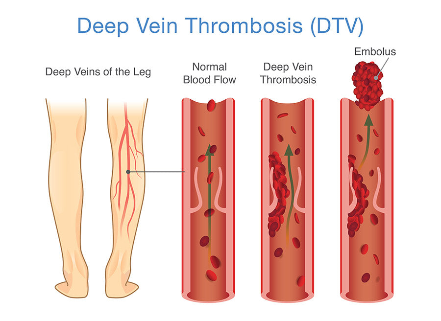 deep vein thrombosis