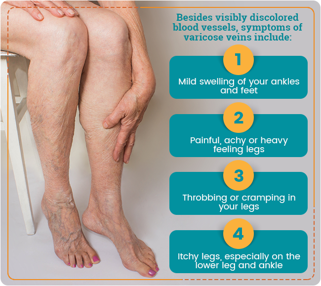 Compression Therapy for Varicose Veins – Ames Walker