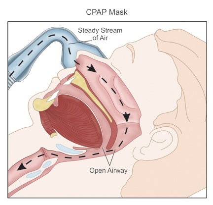 Continuous Positive Airway Pressure (CPAP) Machine: How it Works – Perth  CPAP