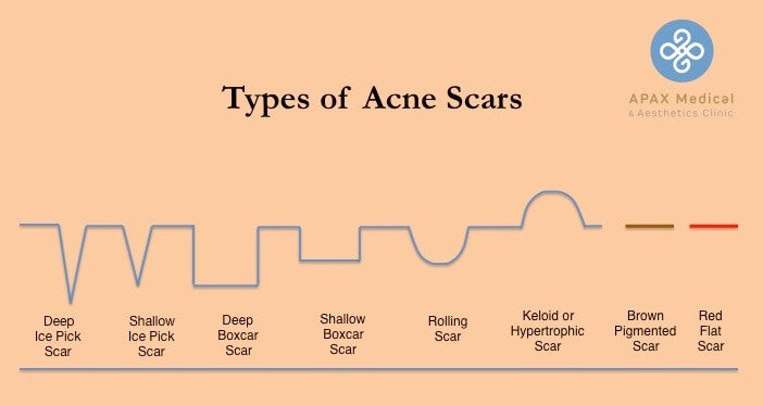 Type of Acne Scars - APAX Medical and Aesthetics Clinic