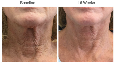 Woman's neck before & after pictures using Restorative Neck Complex with Trihex Technology