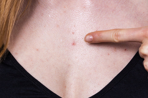 up-close of chest acne