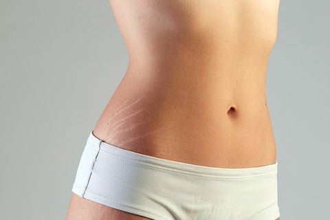 Get rid of stretch marks