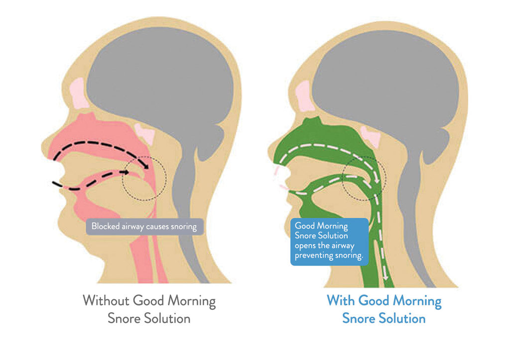 What is Tongue Stabilization?