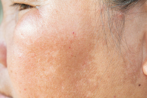 Skin discolouration