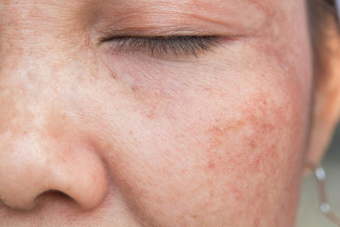 treatment for hyperpigmentation