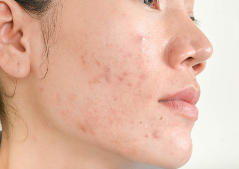 adult acne causes and treatment
