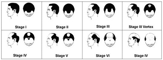 Norwood-Hamilton Scale