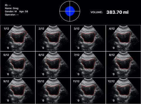 Bladder-Scan-Images