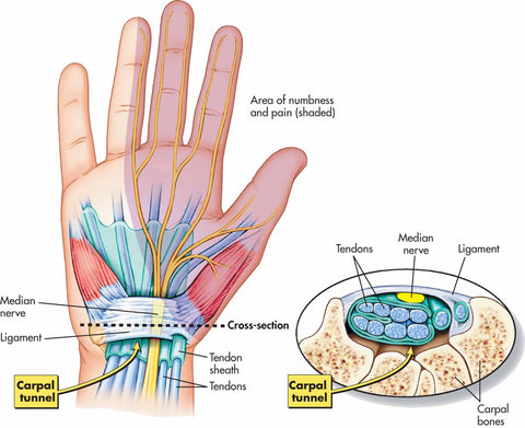 Nerves in hand and wrist that lead to arthritis when lifting