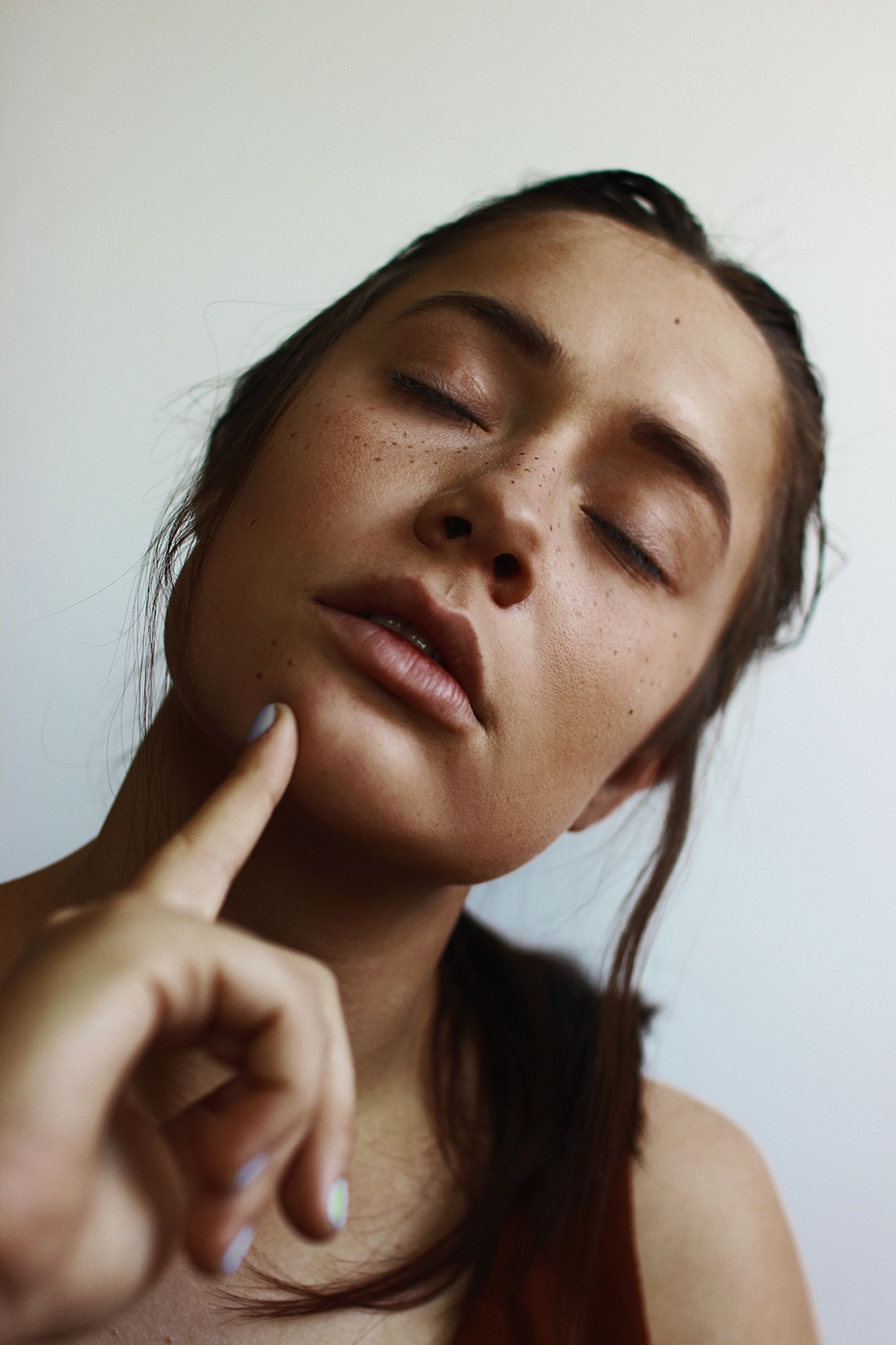 All About Melasma