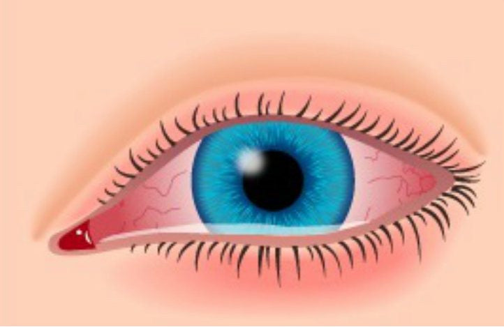 pink eye(allergic)