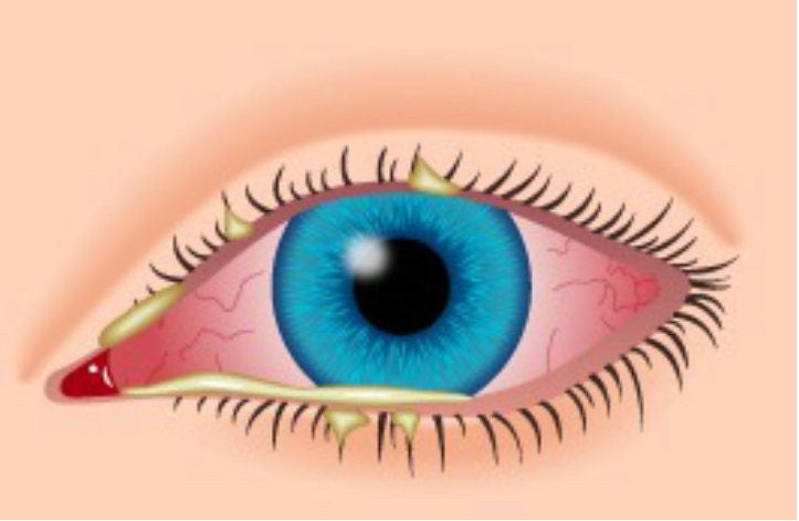 pink eye(bacterial)