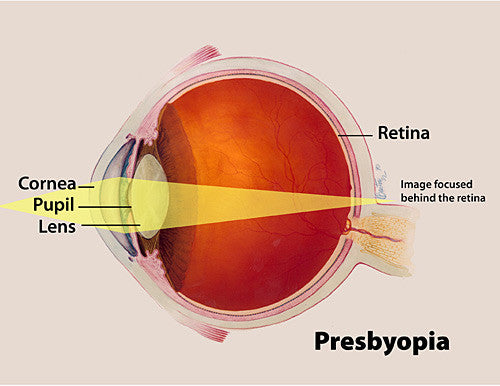 Presbyopia image