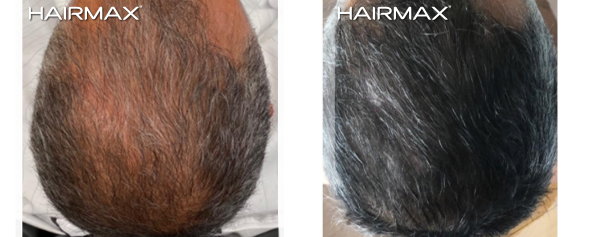 HairMax Before & After Results