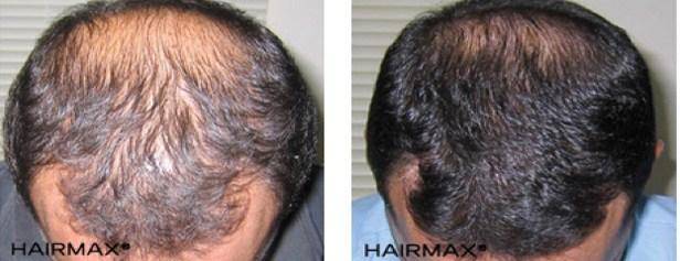 HairMax Before & After Results