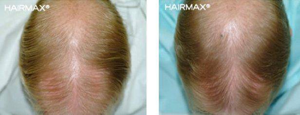 HairMax Before & After Results