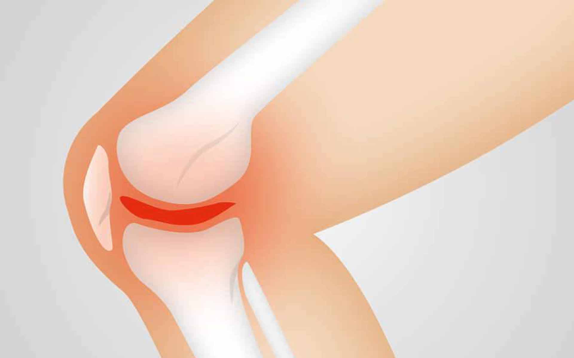 Factores de riesgo en un esguince de rodilla