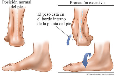 pronación excesiva