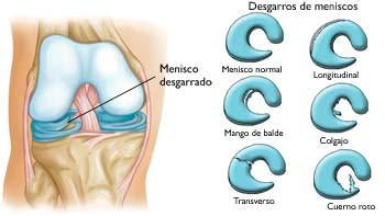 meniscos rodilla