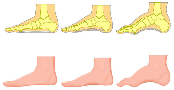 tipos de arco plantar