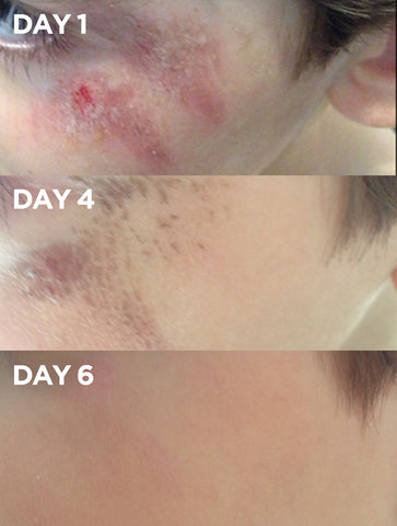 Before & After of Grazes with Golden Dry Skin 'Miracle' Salve