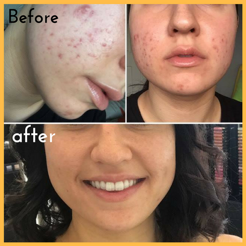 before and after problem skin