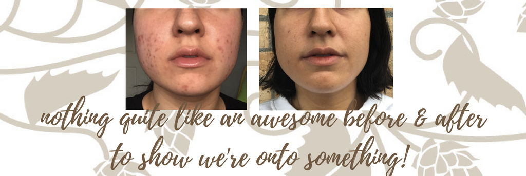 oxygen skincare problem skin before and after