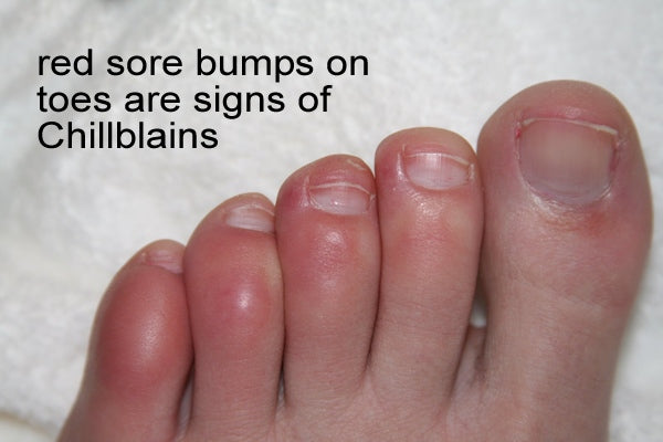 Chilblains on Feet Toes
