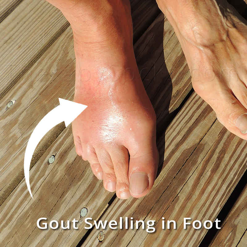 What does Gout Look Like in my Feet