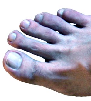 Blue Toe Syndrome
