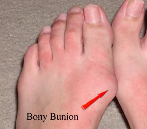 Boney Bunsion on Foot