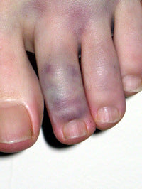 Broken toe with brusing