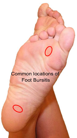 Cirles show Common locations of Foot Bursitis