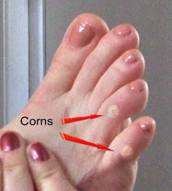 Arrows showing common location of corns on toes