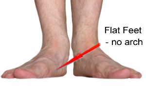 Flat Feet have collapsed arches