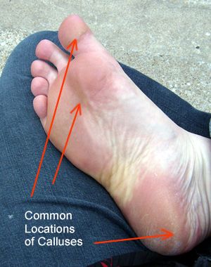 Locations of Foot Calluses