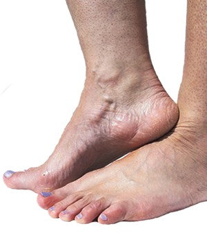 many people suffer from Raynaud's in their Feet