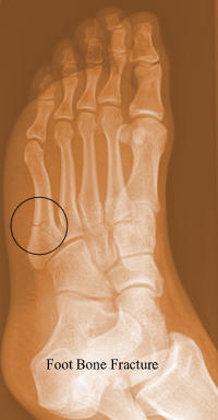 foot bone fracture