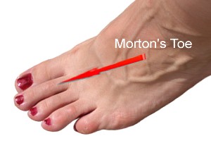 Long second toe is called a Morton's Toe