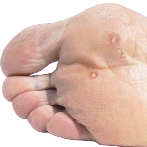 Typical locations of Plantar Warts