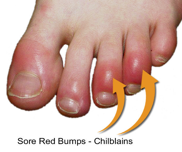 red sore bumps on toes are signs of Chilblains