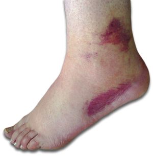 Sprained Ankle Shows bruising and inflammation