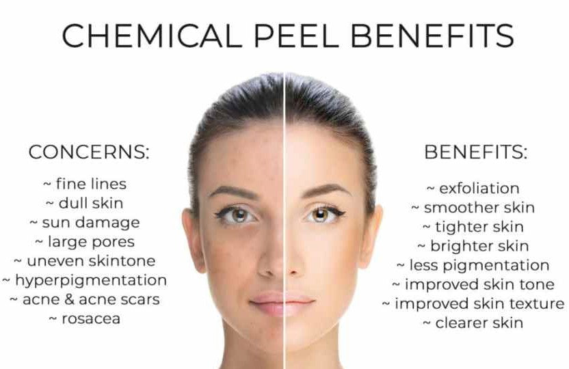 Mooi ontsmettingsmiddel Opiaat Chemical Peel Benefits – Dermatologist's Choice Skincare