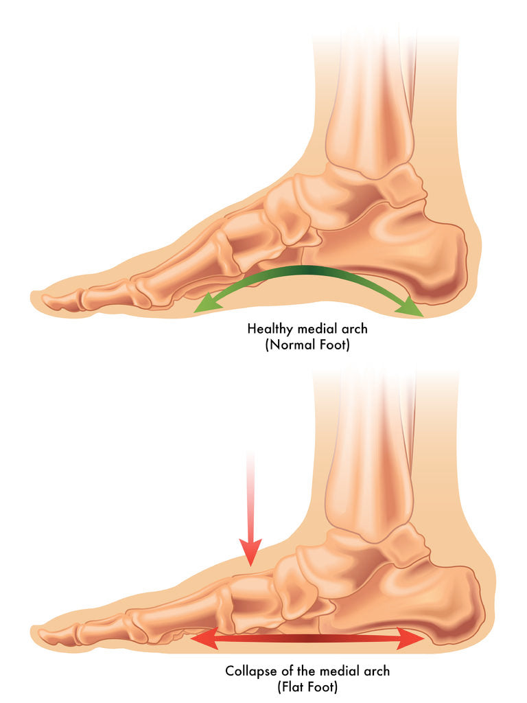 What is Flat Feet?