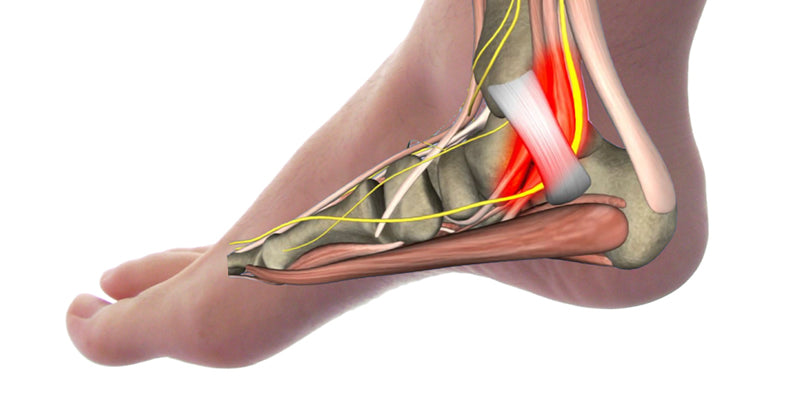 Tarsal Tunnel Syndrome