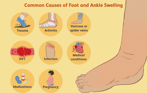 swellnomore cures swollen feet fast and naturally
