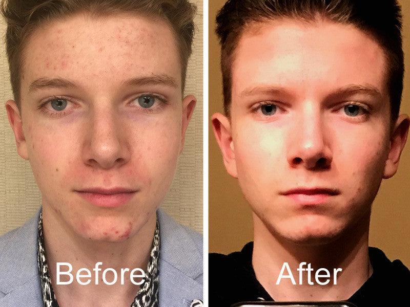 before and after AcneLXR