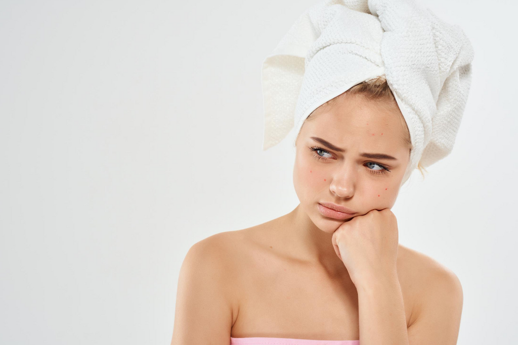 Teenage girl looking unhappy from her acne breakouts. 